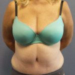 Abdominoplasty Before & After Patient #3539