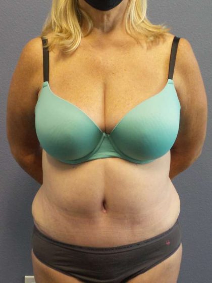 Abdominoplasty Before & After Patient #3539