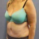 High BMI (Larger Patients) Surgery Before & After Patient #10367