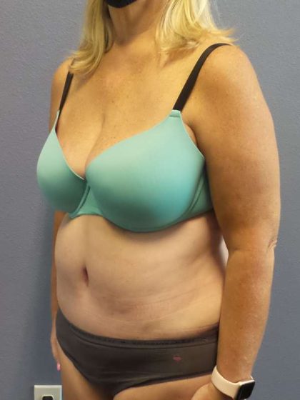 Abdominoplasty Before & After Patient #3539