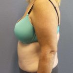 High BMI (Larger Patients) Surgery Before & After Patient #10367