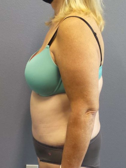 Abdominoplasty Before & After Patient #3539