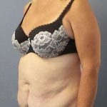 High BMI (Larger Patients) Surgery Before & After Patient #10367