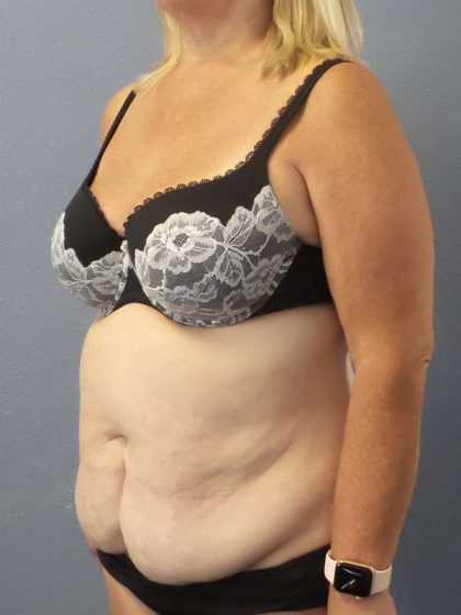 High BMI (Larger Patients) Surgery Before & After Patient #10367