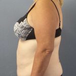 High BMI (Larger Patients) Surgery Before & After Patient #10367