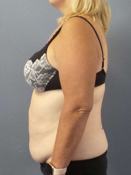 Abdominoplasty Before & After Patient #3539