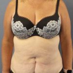 High BMI (Larger Patients) Surgery Before & After Patient #10367
