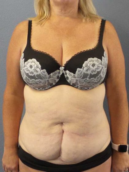 High BMI (Larger Patients) Surgery Before & After Patient #10367