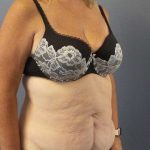 Abdominoplasty Before & After Patient #3539