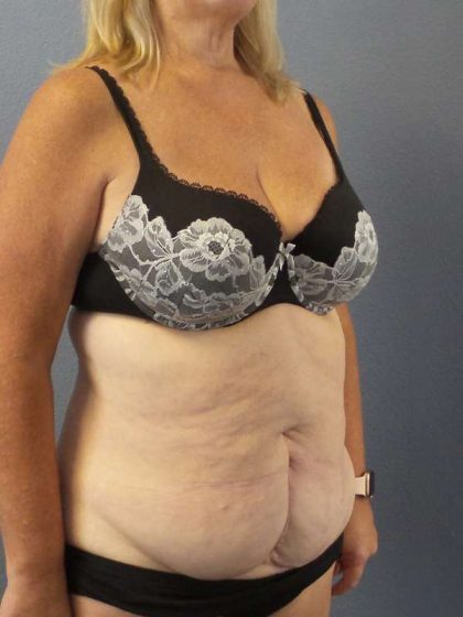 Abdominoplasty Before & After Patient #3539