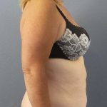 Abdominoplasty Before & After Patient #3539