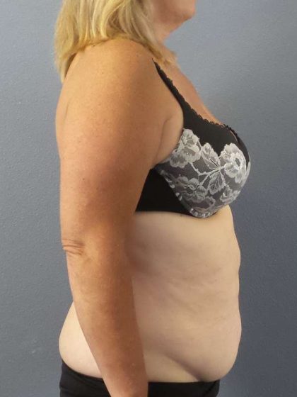 High BMI (Larger Patients) Surgery Before & After Patient #10367