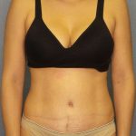 Abdominoplasty Before & After Patient #3561