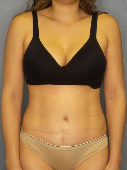 Abdominoplasty Before & After Patient #3561