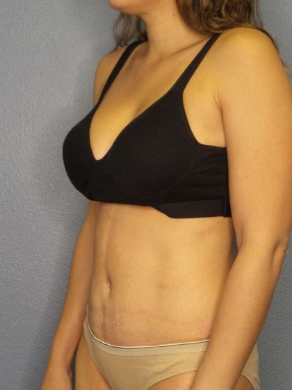 Abdominoplasty Before & After Patient #3561