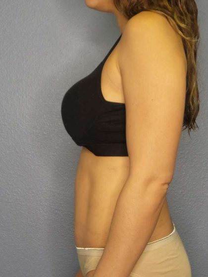 Abdominoplasty Before & After Patient #3561
