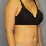 Abdominoplasty Before & After Patient #3561