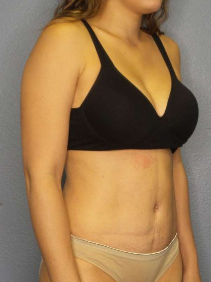 Abdominoplasty Before & After Patient #3561