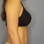 Abdominoplasty Before & After Patient #3561