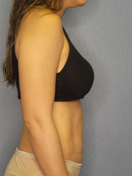 Abdominoplasty Before & After Patient #3561