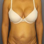 Abdominoplasty Before & After Patient #3561