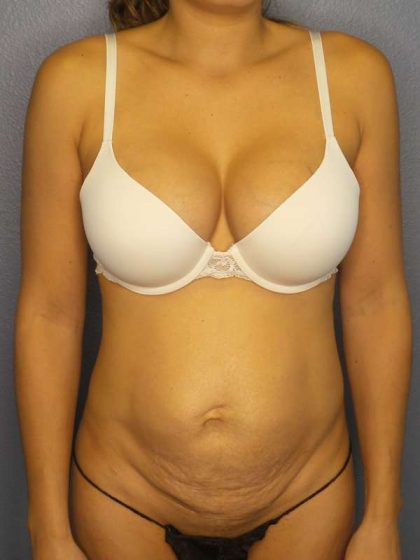 Abdominoplasty Before & After Patient #3561