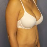 Abdominoplasty Before & After Patient #3561
