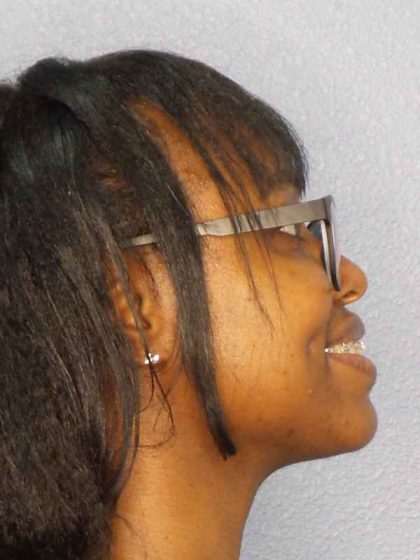 Rhinoplasty Before & After Patient #10124