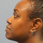 Rhinoplasty Before & After Patient #10124