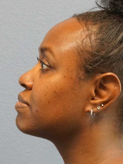 Rhinoplasty Before & After Patient #10124
