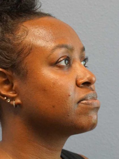 Rhinoplasty Before & After Patient #10124