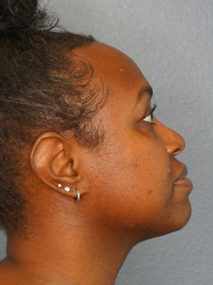 Rhinoplasty Before & After Patient #10124