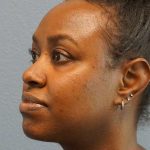 Rhinoplasty Before & After Patient #10124