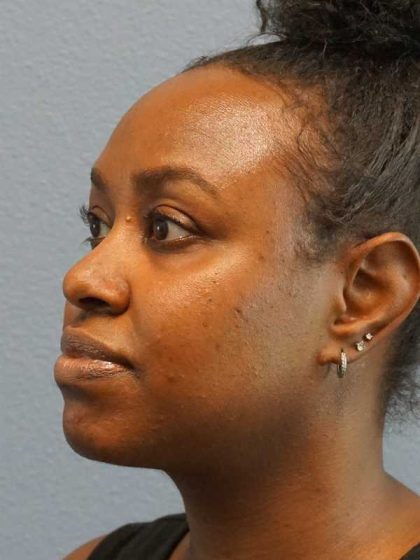 Rhinoplasty Before & After Patient #10124