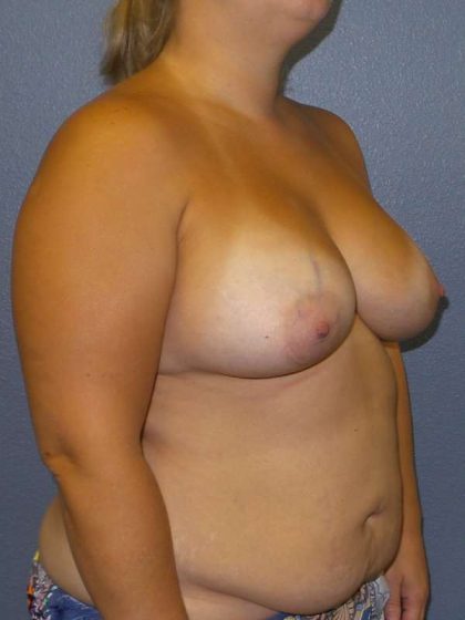 Breast Augmentation Before & After Patient #6572