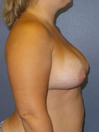 Breast Augmentation Before & After Patient #6572