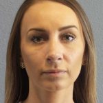 Rhinoplasty Before & After Patient #9823