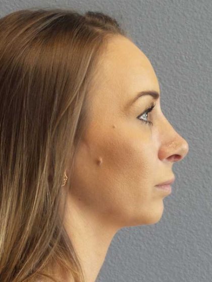 Rhinoplasty Before & After Patient #9823