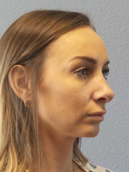 Rhinoplasty Before & After Patient #9823