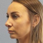Rhinoplasty Before & After Patient #9823