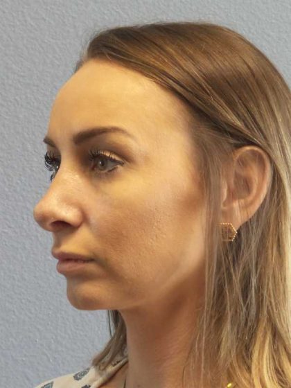 Rhinoplasty Before & After Patient #9823