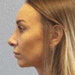 Rhinoplasty Before & After Patient #9823