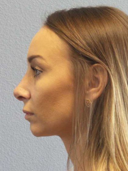 Rhinoplasty Before & After Patient #9823