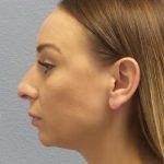 Rhinoplasty Before & After Patient #9823