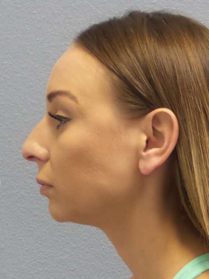 Rhinoplasty Before & After Patient #9823