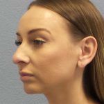 Rhinoplasty Before & After Patient #9823