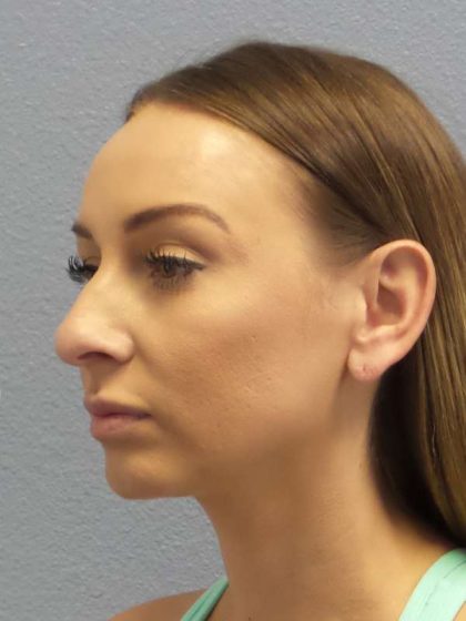 Rhinoplasty Before & After Patient #9823