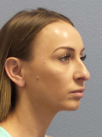 Rhinoplasty Before & After Patient #9823