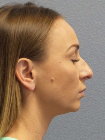 Rhinoplasty Before & After Patient #9823