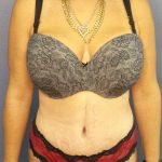 Abdominoplasty Before & After Patient #3426